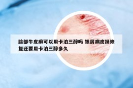 臉部牛皮癬可以用卡泊三醇嗎 銀屑病皮損恢復(fù)還要用卡泊三醇多久