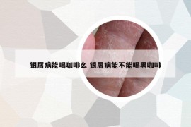 銀屑病能喝咖啡么 銀屑病能不能喝黑咖啡