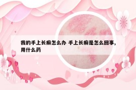 我的手上長癬怎么辦 手上長癬是怎么回事,用什么藥