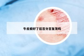 牛皮癬好了后百分百?gòu)?fù)發(fā)嗎