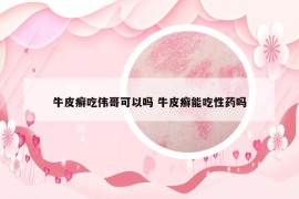 牛皮癬吃偉哥可以嗎 牛皮癬能吃性藥嗎