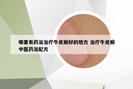 哪里有藥浴治療牛皮癬好的地方 治療牛皮癬中醫(yī)藥浴配方