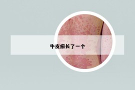 牛皮癬長了一個