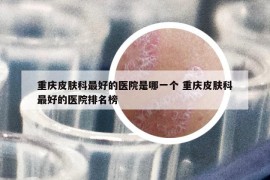 重慶皮膚科最好的醫(yī)院是哪一個(gè) 重慶皮膚科最好的醫(yī)院排名榜
