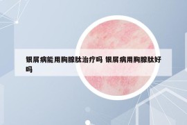 銀屑病能用胸腺肽治療嗎 銀屑病用胸腺肽好嗎