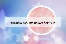 銀屑病引起咽炎 銀屑病引起咽炎吃什么藥