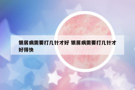 銀屑病需要打幾針才好 銀屑病需要打幾針才好得快
