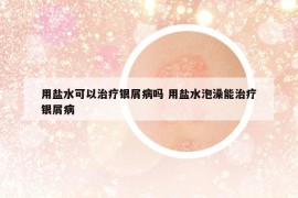 用鹽水可以治療銀屑病嗎 用鹽水泡澡能治療銀屑病