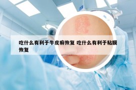 吃什么有利于牛皮癬恢復(fù) 吃什么有利于粘膜恢復(fù)
