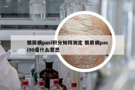 銀屑病pasi積分如何測定 銀屑病pasi90是什么意思