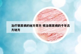 治療銀屑病的秘方奇方 根治銀屑病的千年古方秘方