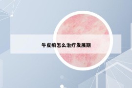 牛皮癬怎么治療發(fā)展期