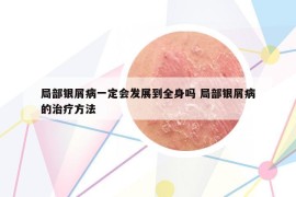 局部銀屑病一定會(huì)發(fā)展到全身嗎 局部銀屑病的治療方法