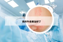 我的牛皮癬治好了