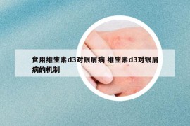食用維生素d3對銀屑病 維生素d3對銀屑病的機制
