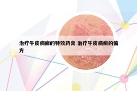 治療牛皮病癬的特效藥膏 治療牛皮病癬的偏方