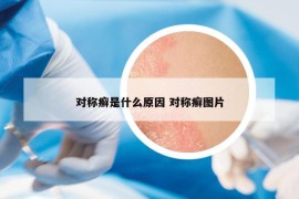 對稱癬是什么原因 對稱癬圖片