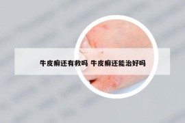 牛皮癬還有救嗎 牛皮癬還能治好嗎