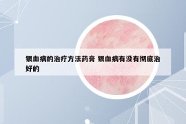 銀血病的治療方法藥膏 銀血病有沒有徹底治好的