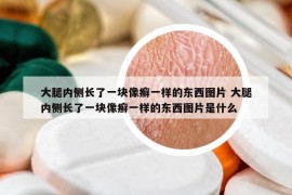 大腿內(nèi)側長了一塊像癬一樣的東西圖片 大腿內(nèi)側長了一塊像癬一樣的東西圖片是什么