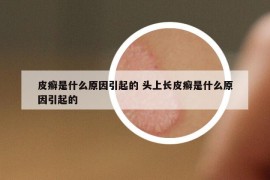 皮癬是什么原因引起的 頭上長皮癬是什么原因引起的