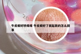 牛皮癬好轉(zhuǎn)癢癢 牛皮癬好了就起新的怎么回事