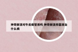 神奇鮮清對牛皮癬管用嗎 神奇鮮清抑菌液治什么病