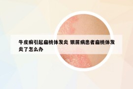 牛皮癬引起扁桃體發(fā)炎 銀屑病患者扁桃體發(fā)炎了怎么辦