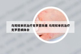 烏司奴單抗治療克羅恩效果 烏司奴單抗治療克羅恩病體會(huì)