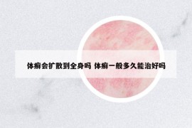 體癬會擴散到全身嗎 體癬一般多久能治好嗎