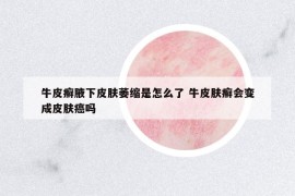 牛皮癬腋下皮膚萎縮是怎么了 牛皮膚癬會(huì)變成皮膚癌嗎