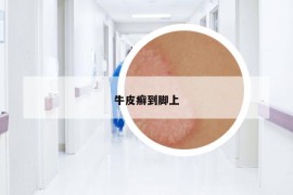 牛皮癬到腳上