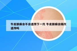 牛皮膚癬會(huì)不會(huì)遺傳下一代 牛皮膚癬會(huì)隔代遺傳嗎
