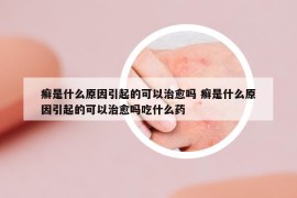 癬是什么原因引起的可以治愈嗎 癬是什么原因引起的可以治愈嗎吃什么藥