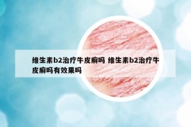 維生素b2治療牛皮癬嗎 維生素b2治療牛皮癬嗎有效果嗎