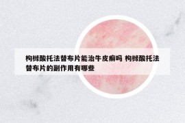 枸櫞酸托法替布片能治牛皮癬嗎 枸櫞酸托法替布片的副作用有哪些