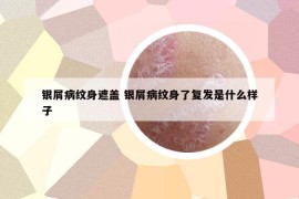 銀屑病紋身遮蓋 銀屑病紋身了復(fù)發(fā)是什么樣子