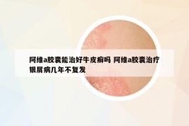阿維a膠囊能治好牛皮癬嗎 阿維a膠囊治療銀屑病幾年不復(fù)發(fā)