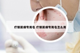 療銀屑病專用皂 療銀屑病專用皂怎么用