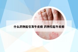 什么藥物能引發(fā)牛皮癬 藥物引起牛皮癬