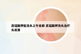 高錳酸鉀能洗頭上牛皮癬 高錳酸鉀洗頭治療頭皮屑