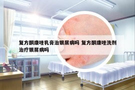 復(fù)方酮康唑乳膏治銀屑病嗎 復(fù)方酮康唑洗劑治療銀屑病嗎