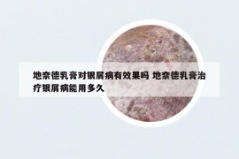 地奈德乳膏對(duì)銀屑病有效果嗎 地奈德乳膏治療銀屑病能用多久