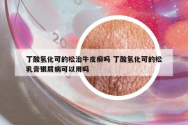 丁酸氫化可的松治牛皮癬嗎 丁酸氫化可的松乳膏銀屑病可以用嗎