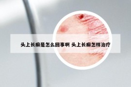 頭上長癬是怎么回事啊 頭上長癬怎樣治療