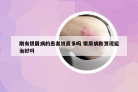 剛有銀屑病的患者脫屑多嗎 銀屑病剛發(fā)現(xiàn)能治好嗎