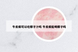 牛皮癬可以吃椰子汁嗎 牛皮癬能喝椰子嗎