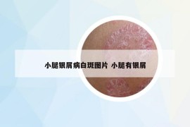 小腿銀屑病白斑圖片 小腿有銀屑