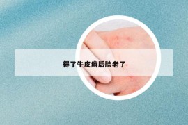 得了牛皮癬后臉老了
