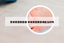 苯烯莫德銀屑病 苯烯莫德銀屑病能治好嗎